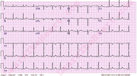 Sinus Arrhythmia ECG 2 | LearntheHeart.com