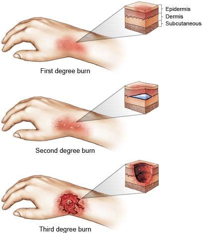 FIRST DEGREE BURNS - Burn Survivor