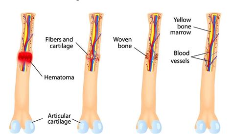 What is the Bone Healing Process? - Dr TDR Reddy