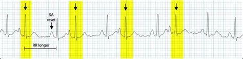 Sinus rhythm with pac ecg 671152-Sinus rhythm with pac treatment