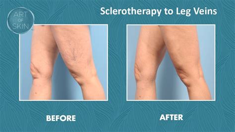 Leg vein treatment with foam sclerotherapy - YouTube