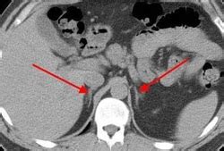 Adrenal Gland - Radiology