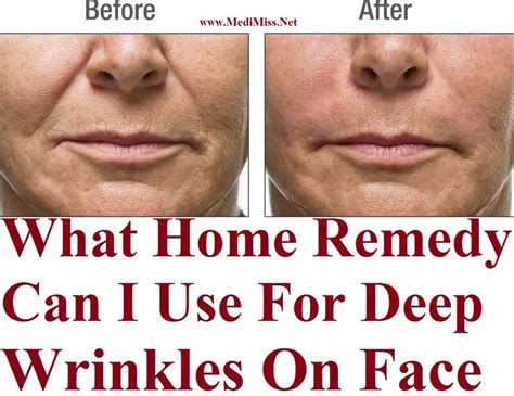 What Home Remedy Can I Use For Deep Wrinkles On Face | Face wrinkles ...