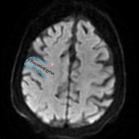 Neuroanatomy Glossary: Precentral Gyrus Stroke | Draw It to Know It