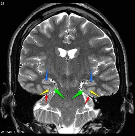 Area Postrema Mri Anatomy