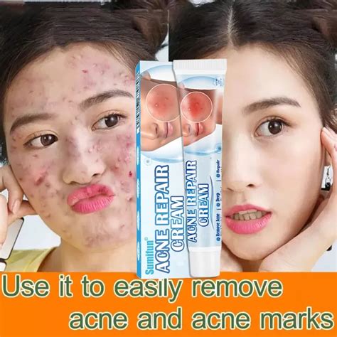 100% Original Acne Pimples Remover Cream Pimple Remover Acne Cream ...