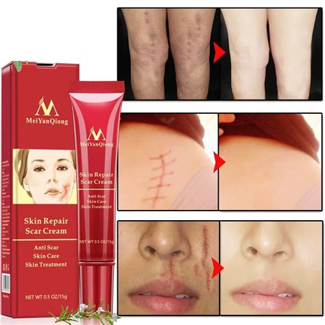 New! Acne Scar Removal Cream Skin Repair Face Cream Acne Spots Acne ...