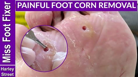 Satisfying deep corns removal with callus - YouTube