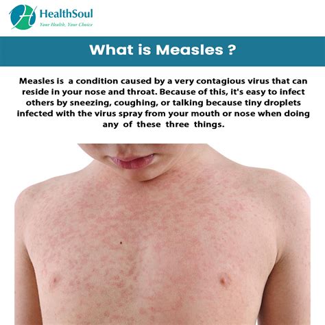 Measles: Symptoms and Treatment – Healthsoul