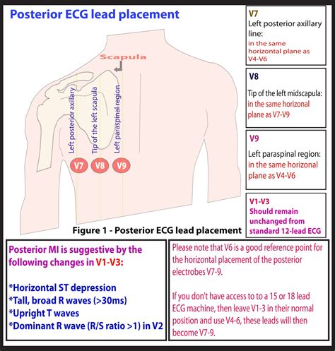 15 Lead Ecg Placement Diagram