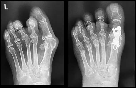 1st MTPJ Fusion | Big Toe Arthrodesis | David Redfern