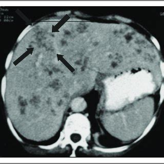 Late stage of acute fasciola infection (5 months of symptoms ...