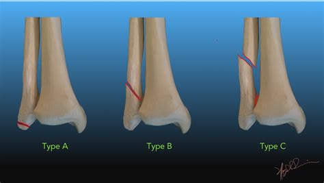 Danis – Weber Classification of Ankle Fractures | UW Emergency Radiology