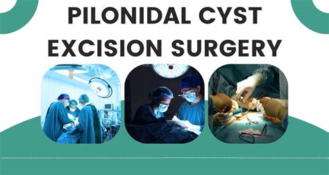 Know about pilonidal cyst excision surgery and incision surgery