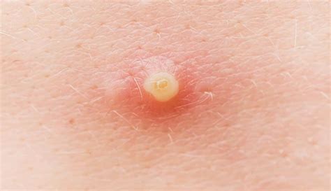 Infected Pimple: What It Looks Like, Causes & Treatment