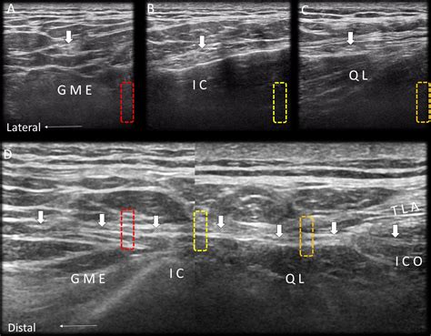 Is it possible to exactly visualize the superior cluneal nerve using ...