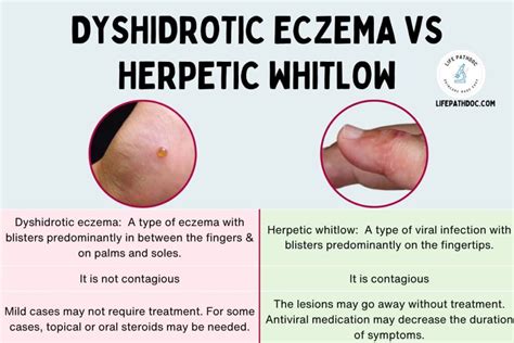 Dyshidrotic Eczema Vs. Herpetic Whitlow