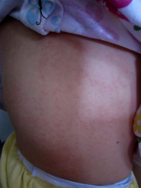 Journey to Motherhood: Rashes After Fever in Children: Symptoms and ...