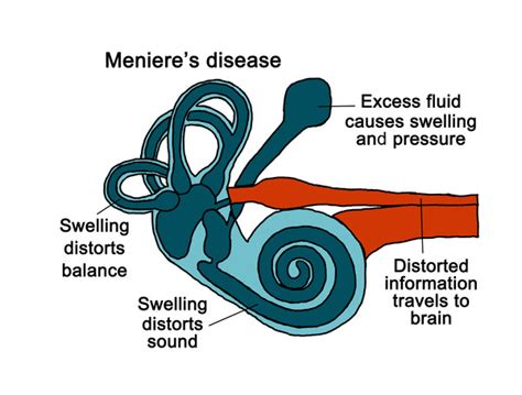 Ménière disease: MedlinePlus Genetics