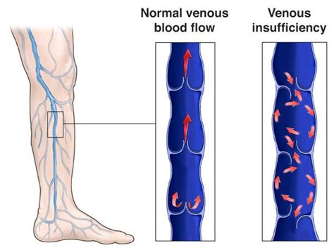 Chronic Venous Insufficiency Pictures, Understanding Chronic Venous ...