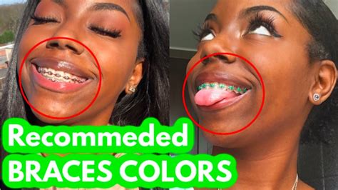 Braces Colors For Dark Skin