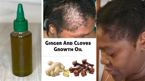 Discover more than 77 clove oil for hair growth super hot - ceg.edu.vn