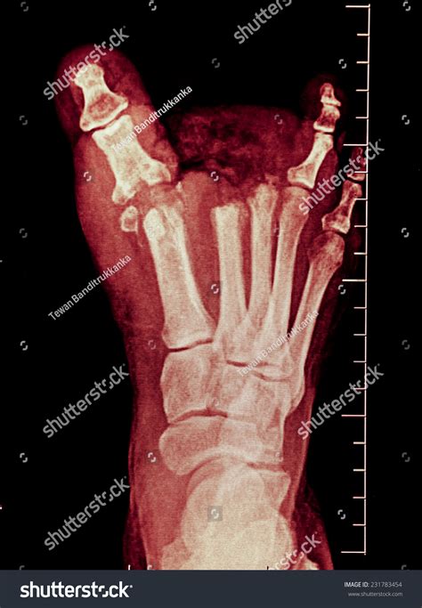 X Ray Broken Toe Stock Photo 231783454 : Shutterstock