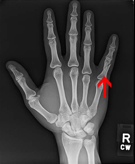 Hand Fractures Treatment and Surgery Specialists in Northern VA