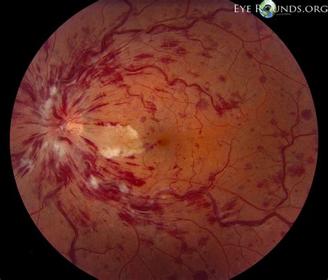 Atlas Entry - Central retinal vein occlusion with cilioretinal artery ...