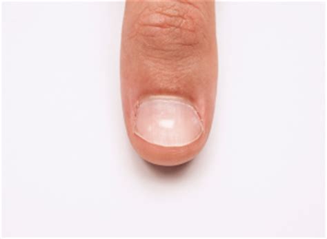 Muehrcke’s Nails: Symptoms, Causes, Treatment | Footfiles