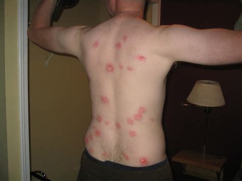 Paintball Welts the Day After | Eric Liu | Flickr