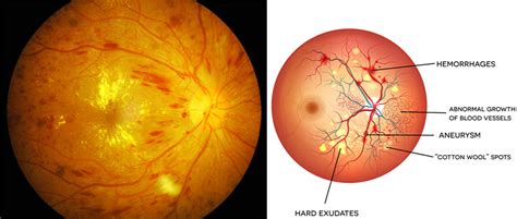 Diabetes Eye Test | Eye Health Examination | Optometrist Kew - EYECARE ...