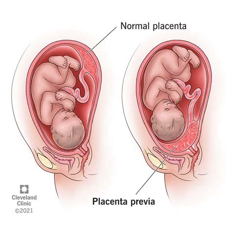 Placenta Previa: Symptoms, Causes & Treatments