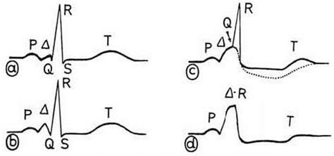 Delta Wave • LITFL Medical Blog • ECG Library Basics