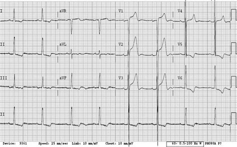 Left Ventricular Hypertrophy (LVH) • LITFL • ECG Library Diagnosis