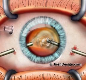 Small incision retina surgery and vitrectomy