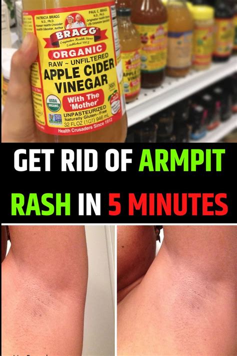 How to Get Rid of Armpit Rash | Armpit rash, The cure, Rashes