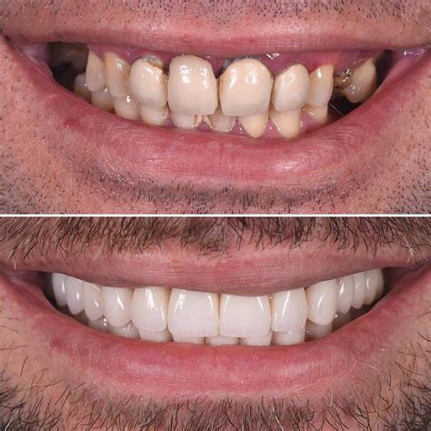 What is the difference between composite veneers and porcelain veneers ...