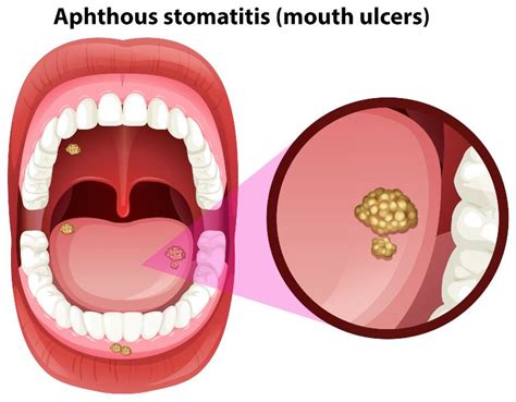 How To Get Rid Of Tongue Blisters - Staybite11