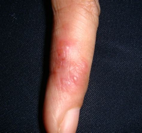 Herpetic Whitlow - Pictures, Symptoms, Treatment, Causes