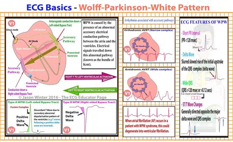 ECG Basics - Ventricular Rhythms #Cardiology #MedStudent #EKG # ...