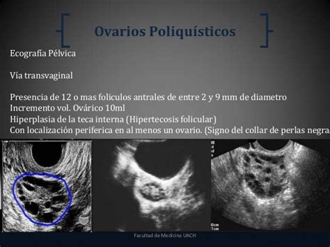 Síndrome de Ovario Poliquístico (PCOS)