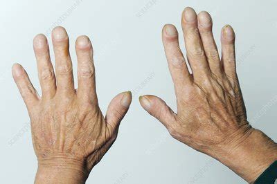 Clubbed fingernails - Stock Image - C010/3263 - Science Photo Library