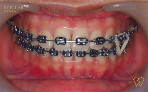 Braces Colors: Top Picks For 2023 - Stellar Dental