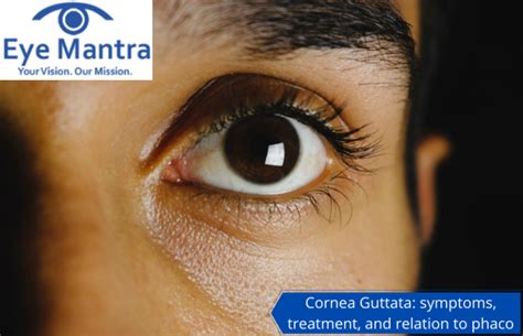 Cornea Guttata: Symptoms And Treatment | How Relate To Phaco