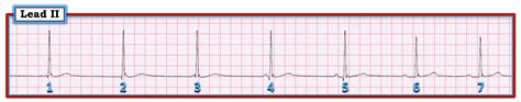 ECG Interpretation: ECG Blog #192 (ECG MP-9) — AV Dissociation by ...