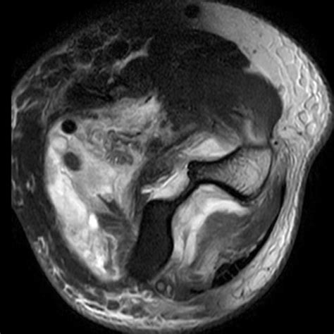 Brachialis Muscle and Tendon Injury | Radsource