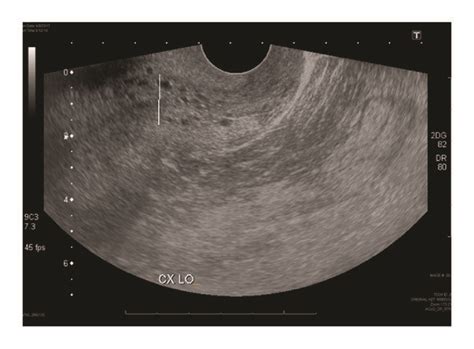 Ultrasound imaging of uterus demonstrating endometrial lining measuring ...