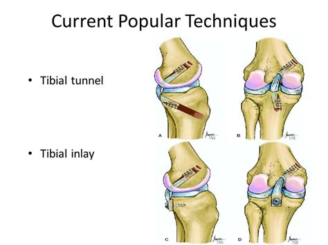 Posterior Cruciate Ligament [PCL] Tear - Sun Orthopaedic