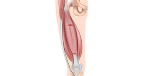 Front Thigh Pain | Anterior Thigh Pain Symptoms, Causes & Treatment